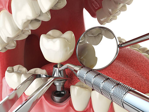 Best Emergency Treatment for Dental Infections or Abscesses in Three Rivers, CA
